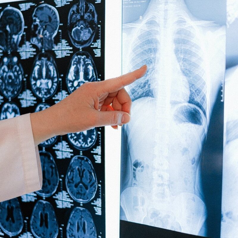x-ray of person-s spine after manual handling injury